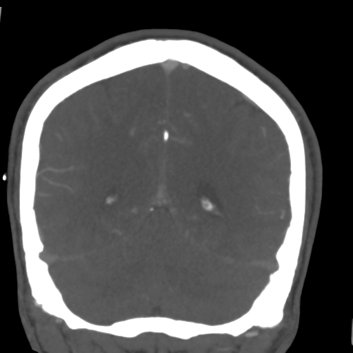 Cerebral arteriovenous malformation (Spetzler-Martin grade 2) (Radiopaedia 41262-44076 F 48).png