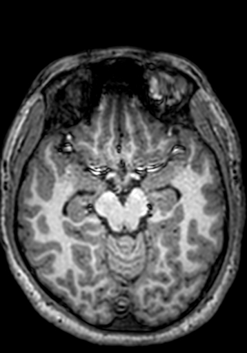Cerebral arteriovenous malformation at posterior body of corpus callosum (Radiopaedia 74111-84925 Axial T1 186).jpg