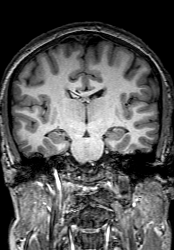 Cerebral arteriovenous malformation at posterior body of corpus callosum (Radiopaedia 74111-84925 Coronal T1 175).jpg
