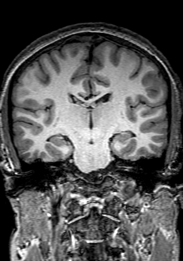Cerebral arteriovenous malformation at posterior body of corpus callosum (Radiopaedia 74111-84925 Coronal T1 182).jpg