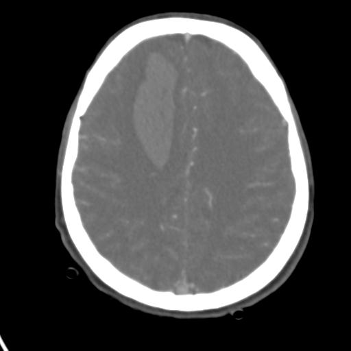 Cerebral arteriovenous malformation with hemorrhage (Radiopaedia 28773-29073 A 18).jpg