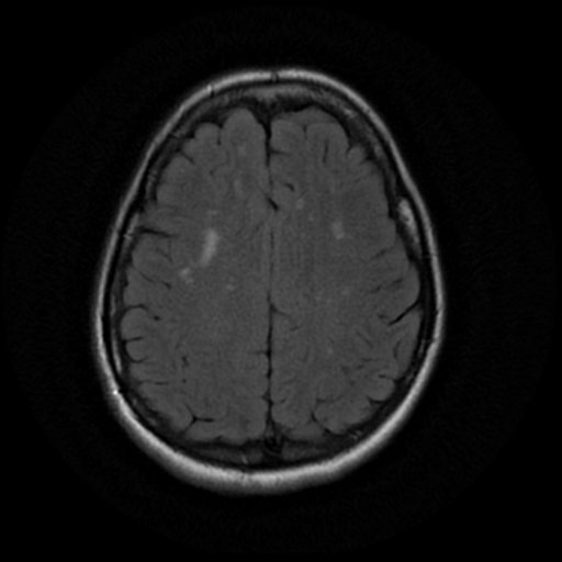 File:Cerebral autosomal dominant arteriopathy with subcortical infarcts and leukoencephalopathy (CADASIL) (Radiopaedia 41018-43763 Ax T2 Flair PROP 15).png