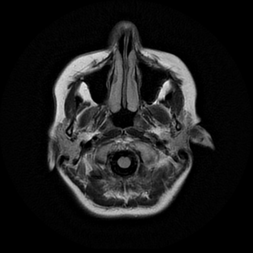 File:Cerebral autosomal dominant arteriopathy with subcortical infarcts and leukoencephalopathy (CADASIL) (Radiopaedia 41018-43768 AX FLAIR (Propeller) 1).png