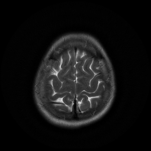 File:Cerebral autosomal dominant arteriopathy with subcortical infarcts and leukoencephalopathy (CADASIL) (Radiopaedia 41018-43768 Ax T2 PROP 18).png