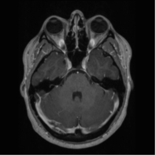 File:Cerebral cavernoma and development venous anomaly (Radiopaedia 37603-39482 Axial T1 C+ 23).png