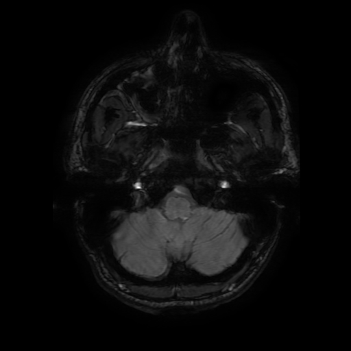 Cerebral cavernous venous malformation (Zabramski type II) (Radiopaedia 85511-101198 Axial SWI 21).jpg