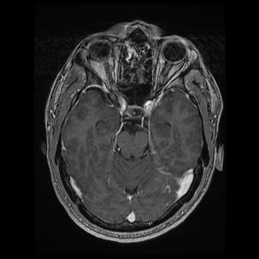 Cerebral cavernous venous malformation (Zabramski type II) (Radiopaedia 85511-101198 Axial T1 C+ fat sat 55).jpg