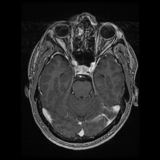 Cerebral cavernous venous malformation (Zabramski type II) (Radiopaedia 85511-101198 Axial T1 C+ fat sat 56).jpg