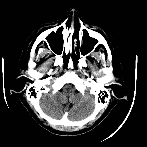 File:Cerebral edema (evolution in time) (Radiopaedia 19418-19440 non-contrast 17).jpg