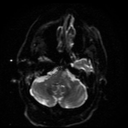 Cerebral embolic infarcts (embolic shower) (Radiopaedia 49837-55108 Axial DWI 38).jpg