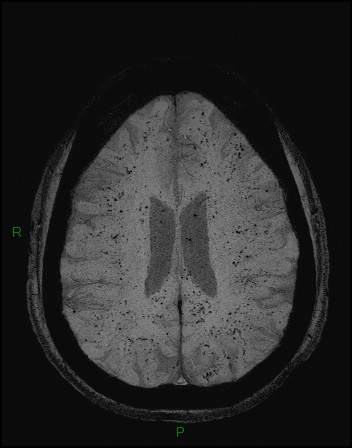 Cerebral fat embolism (Radiopaedia 35022-36525 Axial SWI 34).jpg