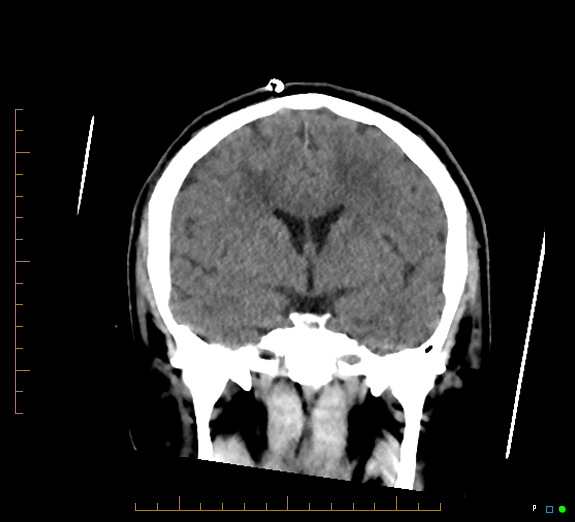 Cerebral fat embolism (Radiopaedia 85521-101220 Coronal non-contrast 30).jpg