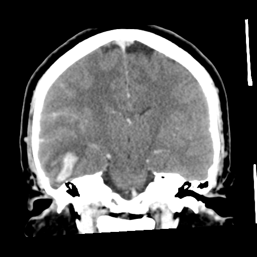 Cerebral hemorrhage secondary to arteriovenous malformation (Radiopaedia 33497-34561 C 36).png