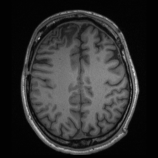 File:Cerebral hemorrhagic contusions- temporal evolution (Radiopaedia 40224-42757 Axial T1 55).png