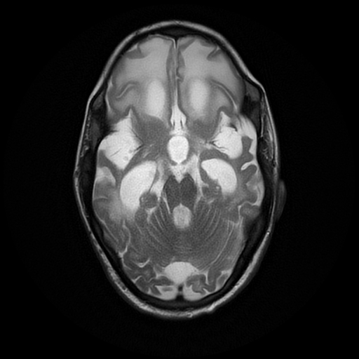 File:Cerebral manifestations of mucopolysaccharidosis type I (Radiopaedia 59171-66487 Axial T2 8).jpg
