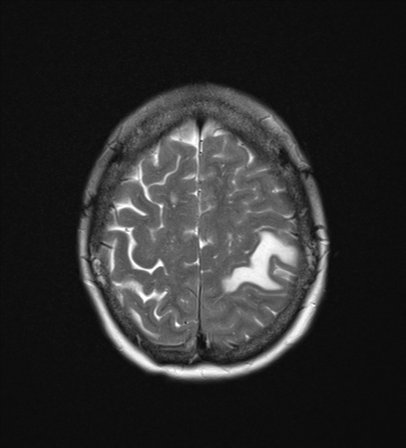 File:Cerebral metastasis (Radiopaedia 46744-51248 Axial T2 23).png