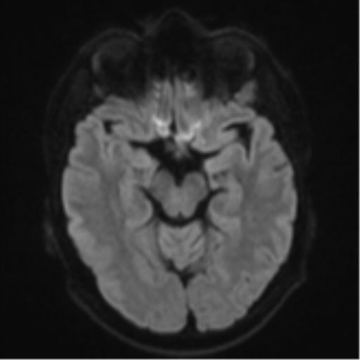 Cerebral metastasis - colorectal adenocarcinoma (Radiopaedia 50394-55765 Axial DWI 38).png