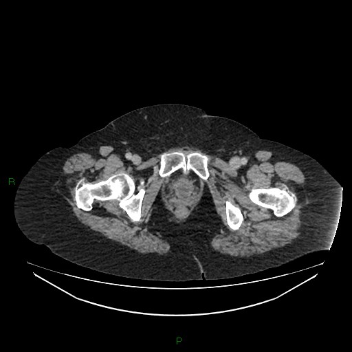 Cerebral metastasis from renal cell carcinoma (Radiopaedia 82306-96378 A 193).jpg