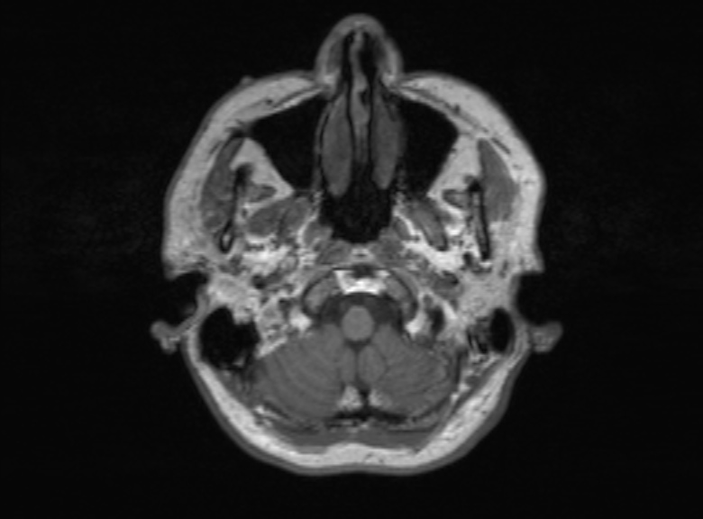 Cerebral ring enhancing lesions - cerebral metastases (Radiopaedia 44922-48817 Axial T1 346).jpg