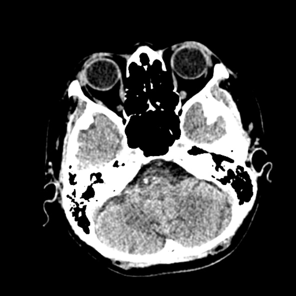 Cerebral ring enhancing lesions - cerebral metastases (Radiopaedia 44922-48818 Axial non-contrast 14).jpg