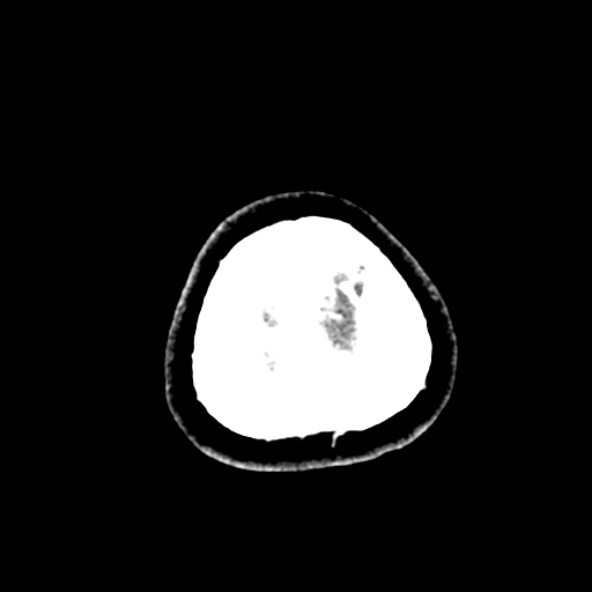 Cerebral ring enhancing lesions - cerebral metastases (Radiopaedia 44922-48818 B 279).jpg