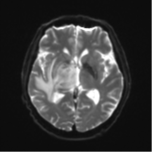 Cerebral toxoplasmosis (Radiopaedia 54575-60804 Axial DWI 17).png