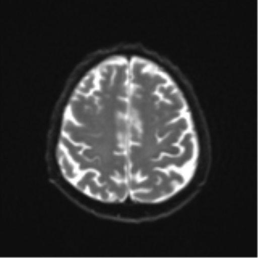 Cerebral toxoplasmosis (Radiopaedia 54575-60804 Axial DWI 25).png