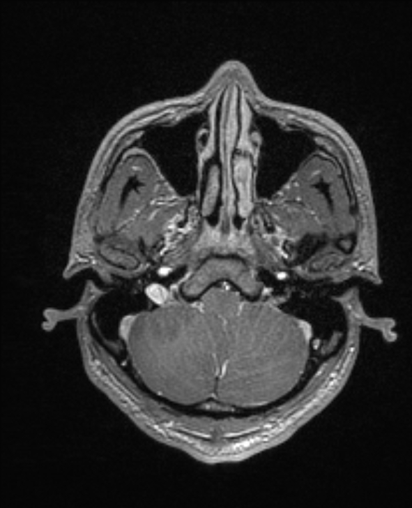 Cerebral toxoplasmosis (Radiopaedia 85779-101597 Axial T1 C+ 30).jpg