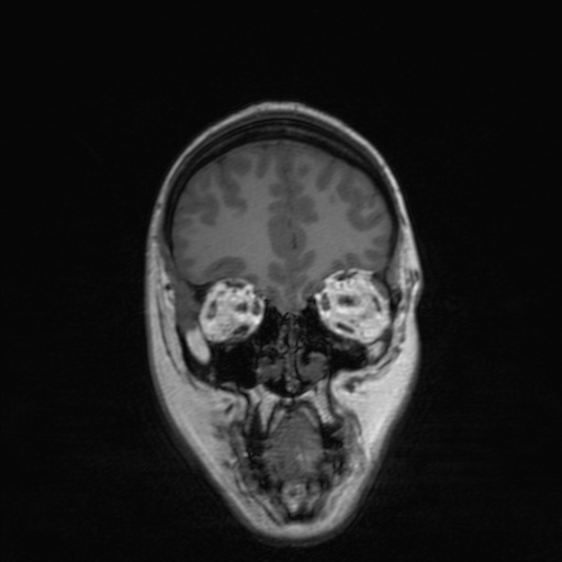 File:Cerebral tuberculosis with dural sinus invasion (Radiopaedia 60353-68090 Coronal T1 45).jpg