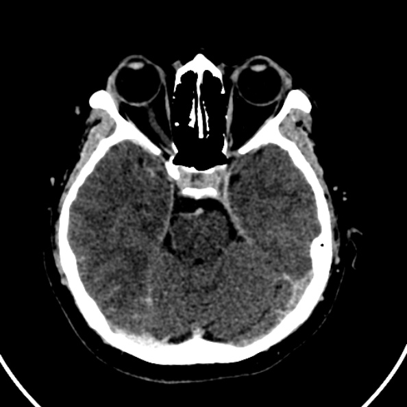 Cerebral venous hemorrhagic infarct from venous sinus thrombosis (Radiopaedia 55433-61883 Axial C+ delayed 101).jpg