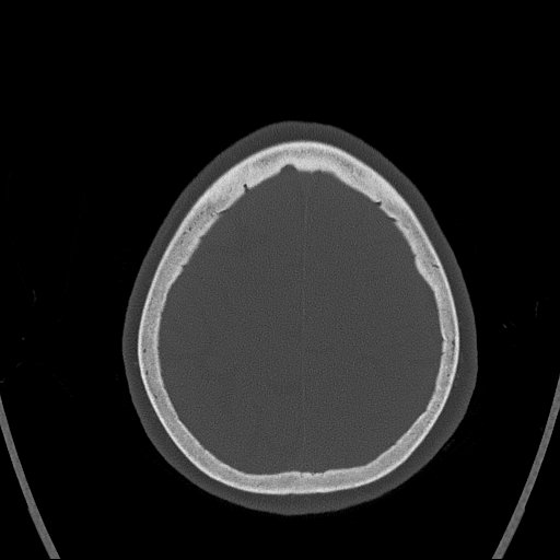 Cerebral venous infarction with hemorrhage (Radiopaedia 65343-74381 Axial bone window 158).jpg