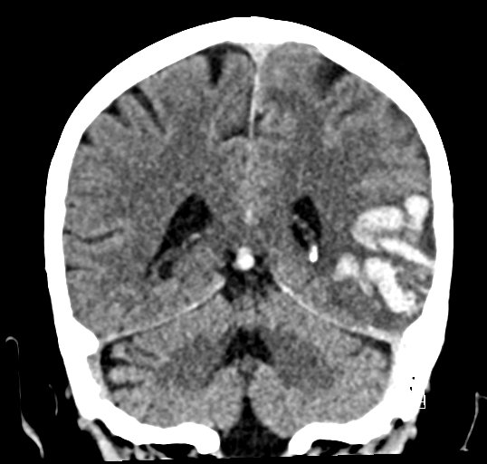 Cerebral venous infarction with hemorrhage (Radiopaedia 65343-74381 Coronal non-contrast 37).jpg