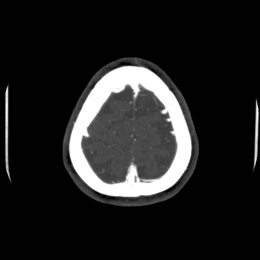 Cerebral venous sinus thrombosis (Radiopaedia 40619-43227 A 206).jpg