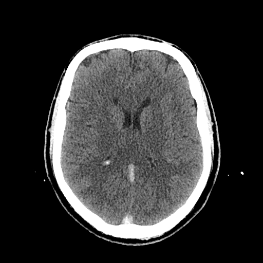 File:Cerebral venous thrombosis (CVT) (Radiopaedia 77524-89685 Axial non-contrast 28).jpg