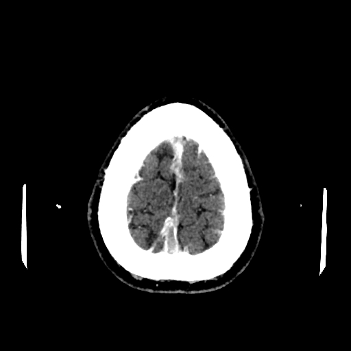 File:Cerebral venous thrombosis (CVT) (Radiopaedia 77524-89685 Axial with contrast 34).jpg