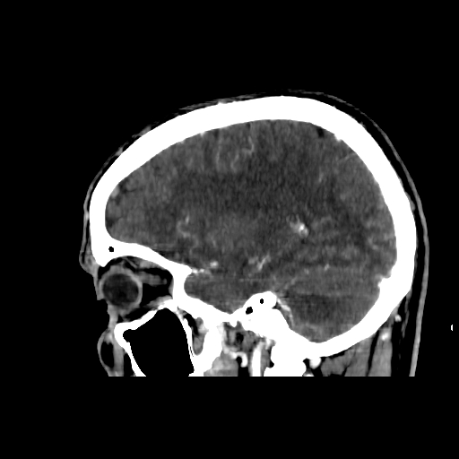 File:Cerebral venous thrombosis (CVT) (Radiopaedia 77524-89685 Sagittal CTV 32).jpg