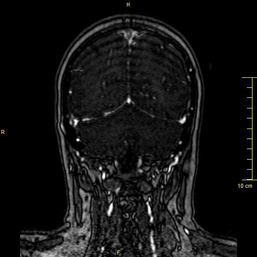 Cerebral venous thrombosis (Radiopaedia 23288-23351 MRV 130).JPG