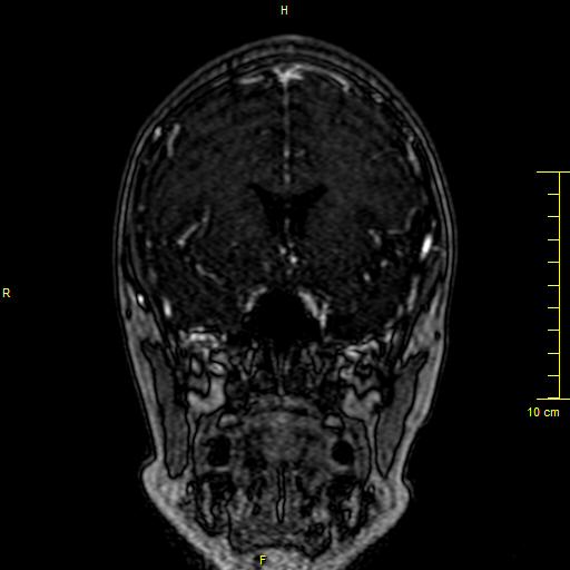 Cerebral venous thrombosis (Radiopaedia 23288-23351 MRV 41).JPG