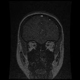 Cerebral venous thrombosis - ulcerative colitis (Radiopaedia 66049-75219 Coronal MRV 93).jpg