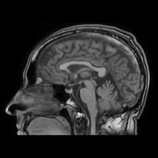 File:Cerebral venous thrombosis with secondary intracranial hypertension (Radiopaedia 89842-106957 Sagittal T1 16).jpg