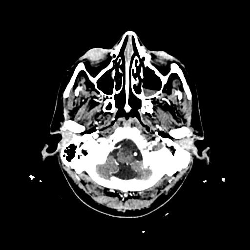 Cerebral venous thrombosis with venous hemorrhagic infarct (Radiopaedia 90354-107660 Axial with contrast 22).jpg