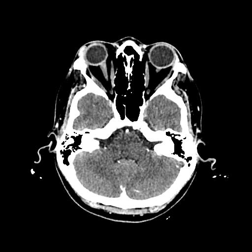 Cerebral venous thrombosis with venous hemorrhagic infarct (Radiopaedia 90354-107660 Axial with contrast 44).jpg
