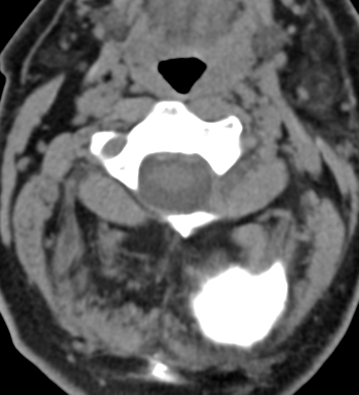 File:Cervical canal stenosis - OPLL and osteophytes (Radiopaedia 47329-51910 Axial non-contrast 18).png