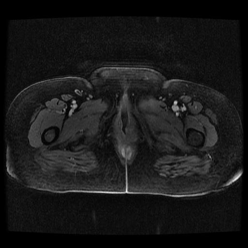 Cervical carcinoma (Radiopaedia 70924-81132 Axial T1 C+ fat sat 105).jpg