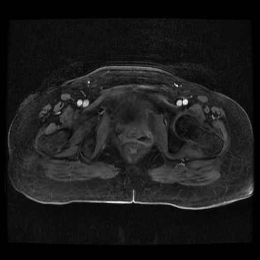 File:Cervical carcinoma (Radiopaedia 70924-81132 Axial T1 C+ fat sat 121).jpg