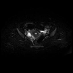 Cervical carcinoma (Radiopaedia 88010-104555 Axial DWI 13).jpg