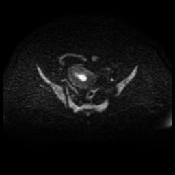 Cervical carcinoma (Radiopaedia 88010-104555 Axial DWI 55).jpg