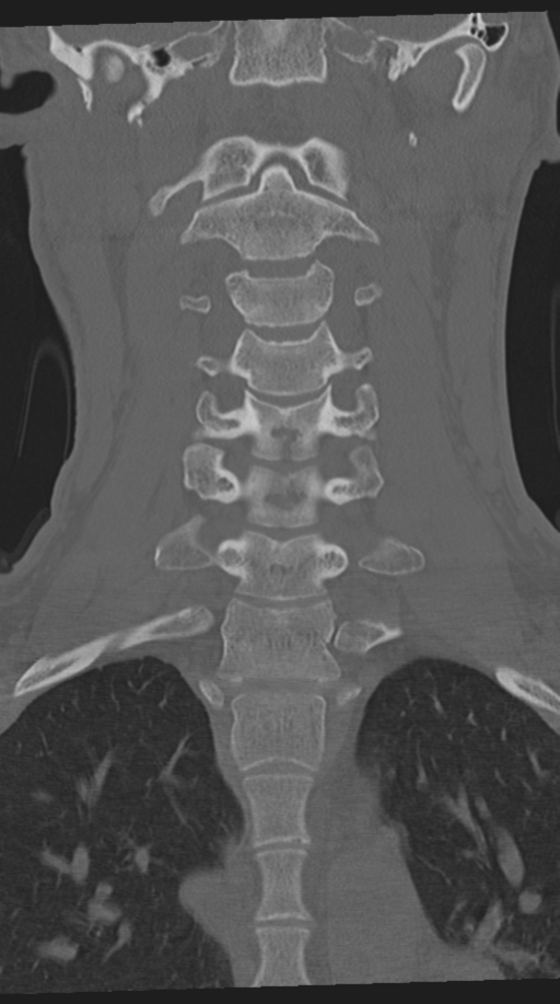 Cervical intercalary bone (Radiopaedia 35211-36748 Coronal bone window 36).png