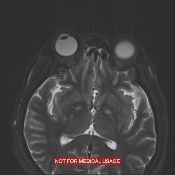 File:Cervical nerve schwannoma (Radiopaedia 27964-28221 C 6).jpg