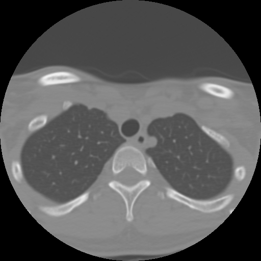 Cervical rib (Radiopaedia 71110-81363 Axial non-contrast 55).jpg